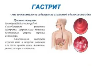 Sensation egy csomó a gyomorban - okok, kezelés, megelőzés (gyomor) Sensation egy csomó a gyomorban - az okok, kezelés, megelőzés