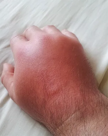 A tumor egy rovarcsípés és hogyan kell helyesen eltávolítani