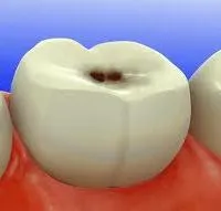 Jellemzői kezelés fogszuvasodás különböző szakaszaiban (különböző) Jellemzői kezelés fogszuvasodás különböző szakaszaiban