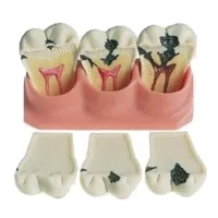 Jellemzői kezelés fogszuvasodás különböző szakaszaiban (caries) Jellemzői kezelés fogszuvasodás különböző szakaszaiban