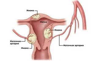 A fő oka a méh mióma a tünetek és patológia