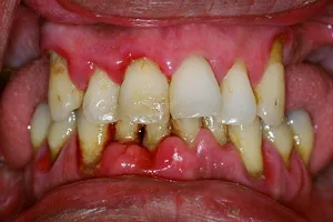 A periodontitis tünetei, okai és paradentózisnál hazai népi jogorvoslati otthon (parodontitis) A periodontitis tünetei, okai és paradentózisnál hazai népi jogorvoslati otthon