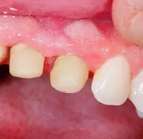 Csonthártyagyulladás mandibula vagy maxilla fotó kezelés hatására (alsó) Csonthártyagyulladás alsó vagy felső állkapocs kép, kezelés, okai