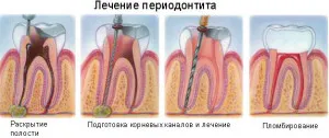 Periodontitis, fogat - mi ez aláírja fotókkal, otthoni kezelés