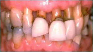 Periodontitis, fogat - mi ez aláírja fotókkal, otthoni kezelés