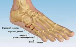 Törés a láb a fő tünetei, kezelése, képek és jelek