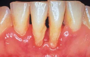 Periodontitis, fogat - mi ez aláírja fotókkal, otthoni kezelés