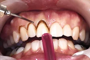 Periodontitis, fogat - mi ez aláírja fotókkal, otthoni kezelés