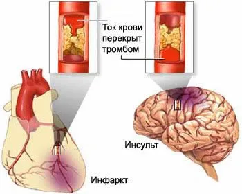 Az első jelei a szívroham és a stroke tüneteinek és prekurzorok a nők és férfiak (jelek) Az első jelei a szívroham és a stroke tüneteinek és prekurzorok a nők és férfiak
