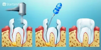 periodontitis kezelésében
