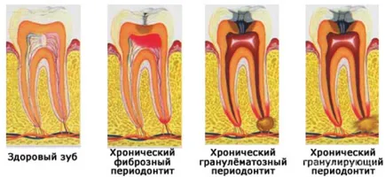 Periodontitis, fogat - mi ez aláírja fotókkal, otthoni kezelés