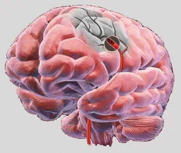Az első jelei és tünetei a stroke és a szívroham a nők elsősegély kezelést (tünetek) Az első jelek és tünetek a stroke és a szívroham nőknél elsősegélynyújtás