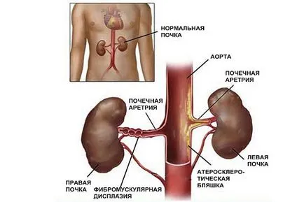Vese tünetek nyomású kezelés, és hogyan kell csökkenteni (nyomás) Vese- tünetei nyomás, kezelések, és hogyan lehet csökkenteni