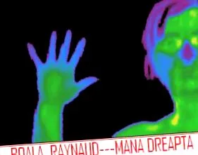raynaud-szindróma medreflexline