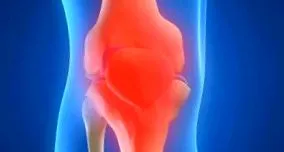 synovitis