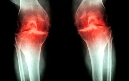 osteoarthritis