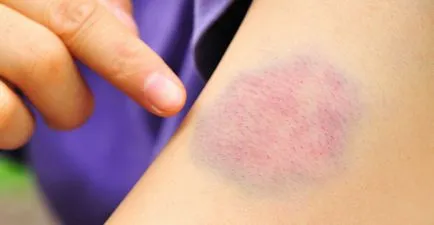 Miért nem zúzódások zúzódások zúzódás okok és a kezelés