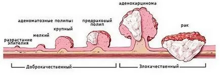 Polypectomia - milyen művelet, és aki megmutatja