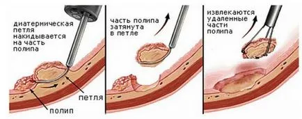 Polypectomia - milyen művelet, és aki megmutatja