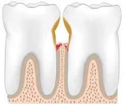 Ellenőrzött népi jogorvoslati kezelésére periodontitis (fogínygyulladás) Bizonyított hagyományos jogorvoslati paradentózisnál
