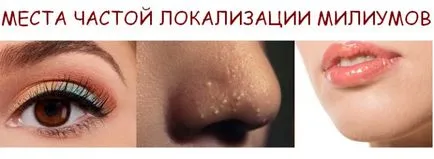 Sordély az arcon okai és hogyan védhetik meg magukat a Corn sármány (megjelenés) Sordély az arcon okai és hogyan védhetik meg magukat a Corn sármány