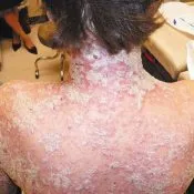După cum poate fi vindecat rapid, scapa de psoriazis (rapid) După cum poate fi vindecat rapid, a scăpa de psoriazis