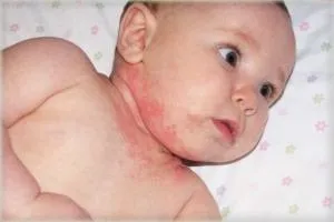 Cum de a vindeca de căldură înțepător la sugari și instrumente de prevenire (foto și video) (tratate) Cum de a vindeca de căldură înțepător la sugari și instrumente de prevenire (foto și video)
