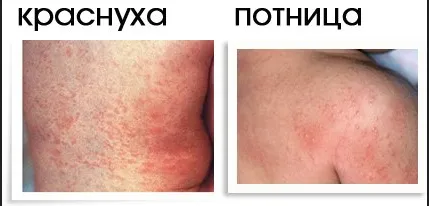 Cum de a vindeca de căldură înțepător la sugari și instrumente de prevenire (foto și video) (tratate) Cum de a vindeca de căldură înțepător la sugari și instrumente de prevenire (foto și video)