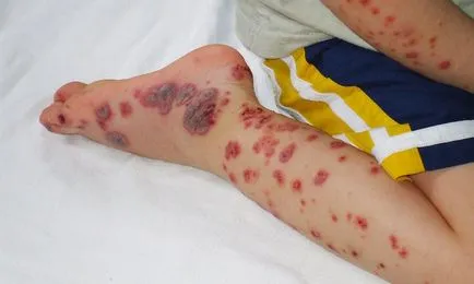 Cum de a vindeca o erupție hemoragică (poate provoca) Cum de a vindeca o erupție cutanată hemoragic