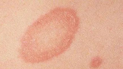 Boala de piele roz provoaca zona zoster la copii, tratamentul (zona zoster) piele roz herpesul boli la copii cauze, tratament