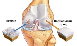 Tratamentul articulațiilor din lista de medicamente cu artrita, pentru utilizarea în recomandări osteoartrita