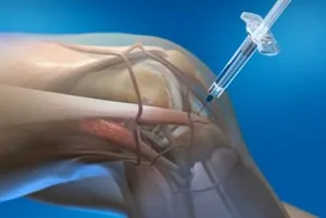 Tratamentul articulațiilor din lista de medicamente cu artrita, pentru utilizarea în recomandări osteoartrita