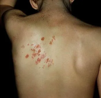 Tratamentul de herpes zoster remedii populare - 5 moduri! (Public) Tratamentul de herpes zoster remedii populare - 5 moduri!