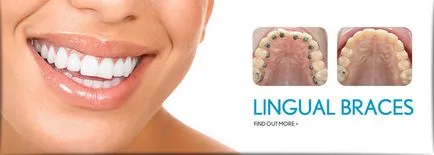 acolade lingual compara branduri la prețul și diferența