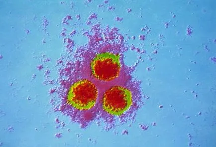 Tratamentul de herpes zoster în căile de atac acasă populare