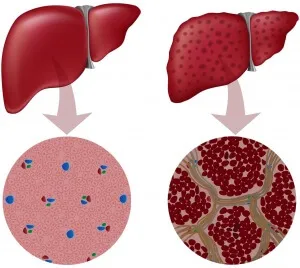 hepatită meniu cu alimente permise si interzise in dieta (hepatita) hepatită meniu cu alimente permise si interzise in dieta