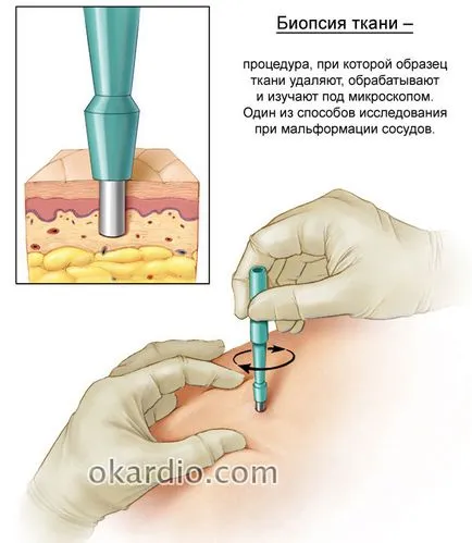 Malformație a creierului si a altor vase, cauza și tratament (vase) Malformație a creierului și a altor nave, cauze si tratament