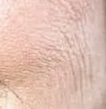 Ridurile - clasificare, cauze de tratament, profilaxie (aspect) Ridurile - clasificare, cauze de, tratament, prevenire