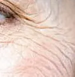 Ridurile - clasificare, cauze de tratament, profilaxie (colagen elastina) Ridurile - clasificare, cauze de, tratament, prevenire