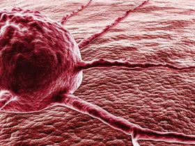 În cazul în care sunt tumorii canceroase (cancer) În cazul în care sunt tumori