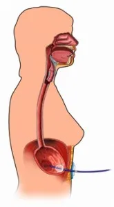 Nutritie dupa o interventie chirurgicala pentru cancer gastric