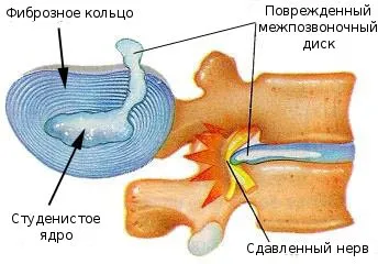 Indicații pentru IRM a coloanei vertebrale, contraindicații