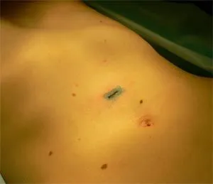 hernie abdomen Postoperator - simptome, tratament, fotografii