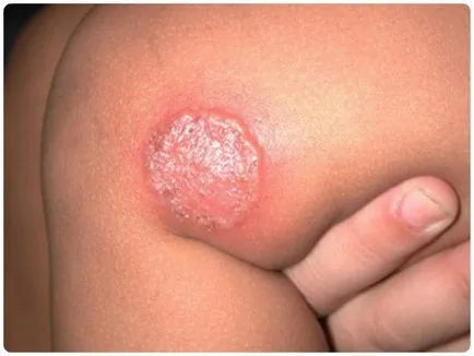 zosterian roz in tratamentul copiilor, diagnostic, simptome, foto (copii) zosterian roz in tratament pentru copii, diagnostic, simptome, fotografii