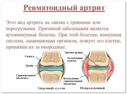 Simptomele și tratamentul de dureri de spate