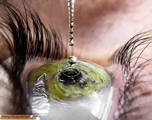 Cum să luați eyedrops durere special înseamnă solicitarea de instilare și ochi