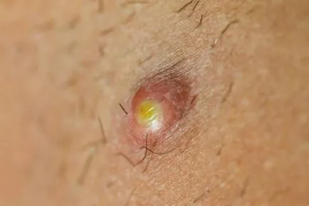 Festered înfășurată 5 moduri de a face fără un medic (rana) Festered înfășurată 5 moduri de a face fără un medic