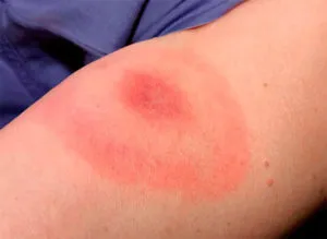 Alergia la lipitori, lipitoare mușcături simptome
