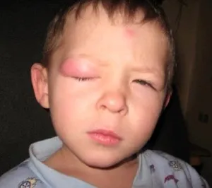 Alergic la înțepături de țânțar la copii fotografie, simptome, tratament (copii) Alergic la înțepături de țânțar la copii fotografie, simptome, tratament