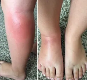 Alergic la mușcăturile de țânțari și musculițe - vara de apel și mâncărime